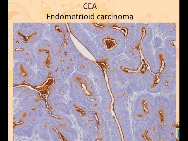CEA Endometrioid carcinoma