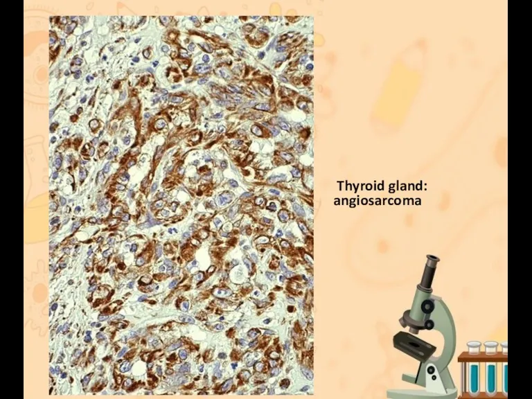 Thyroid gland: angiosarcoma