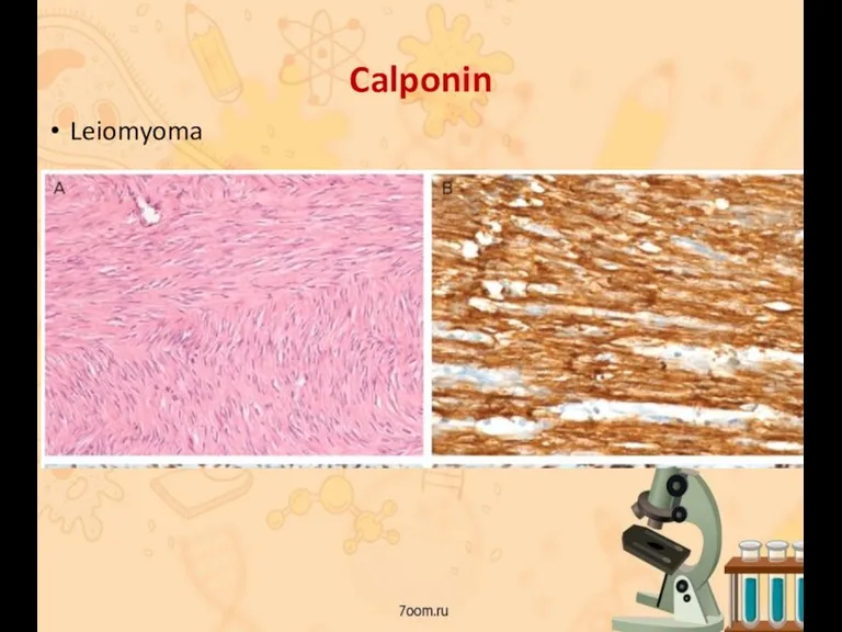 Calponin Leiomyoma