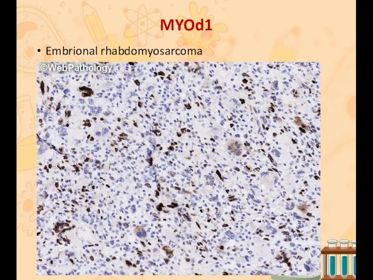 MYOd1 Embrional rhabdomyosarcoma