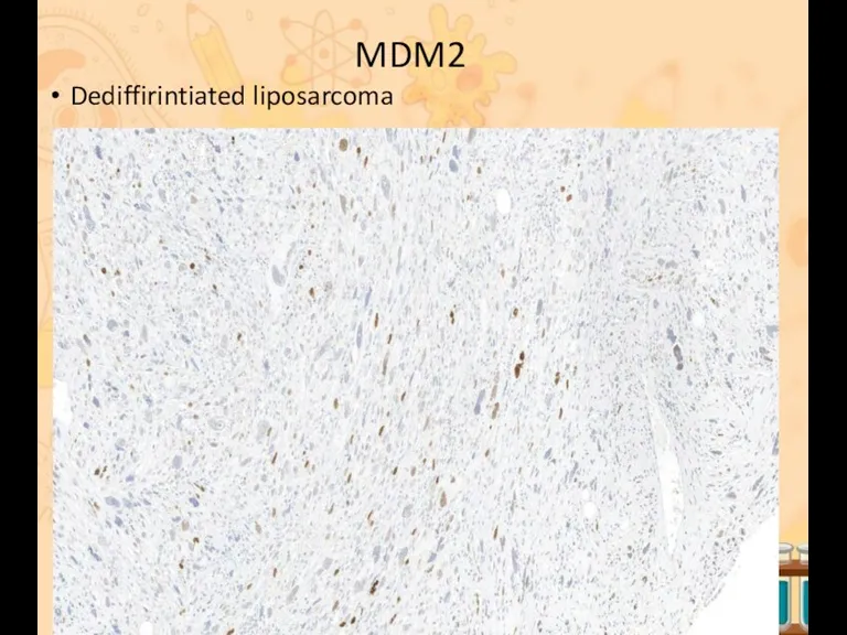MDM2 Dediffirintiated liposarcoma