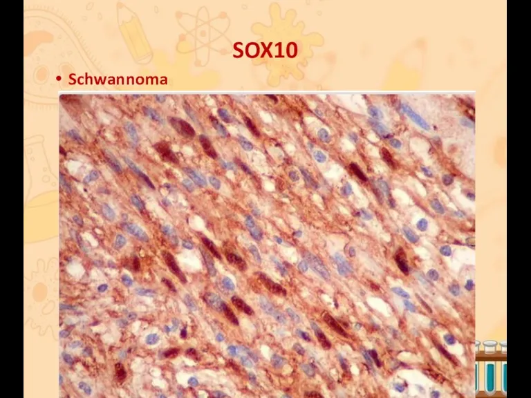 SOX10 Schwannoma