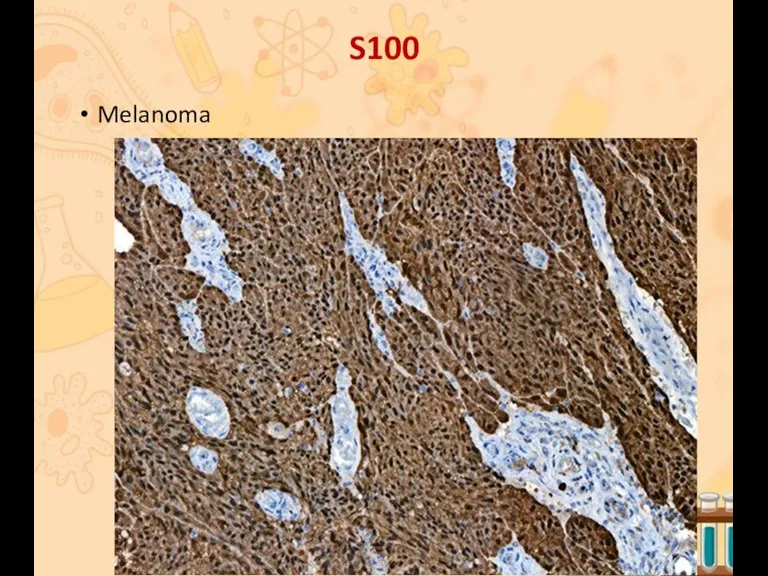 S100 Melanoma