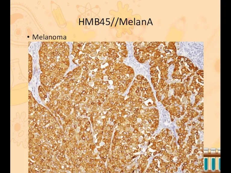 HMB45//MelanA Melanoma