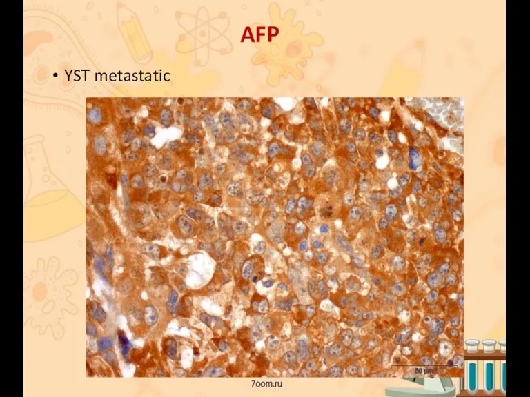 AFP YST metastatic