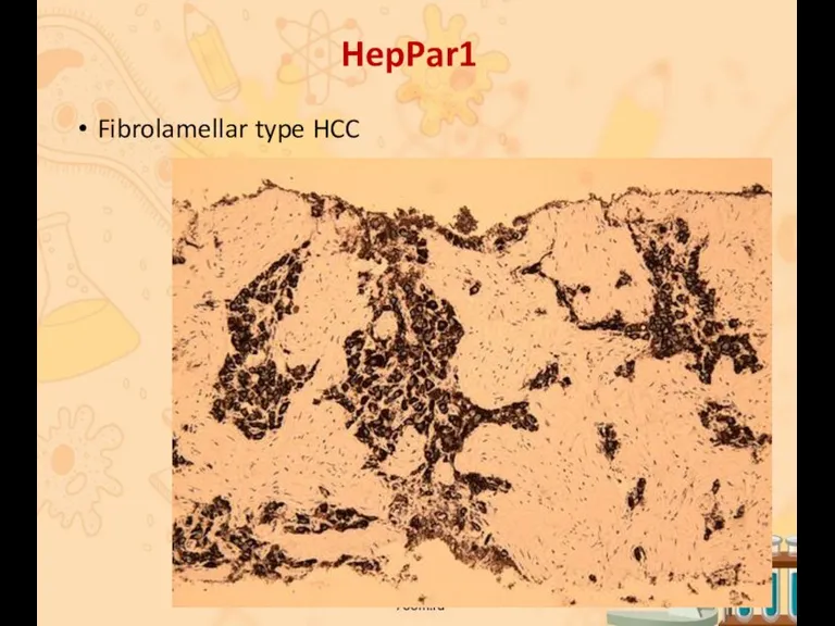 HepPar1 Fibrolamellar type HCC