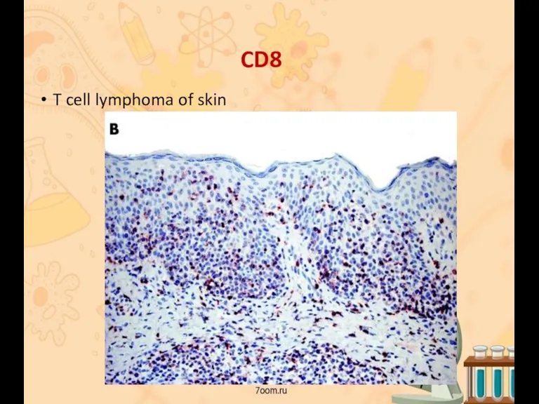 CD8 T cell lymphoma of skin