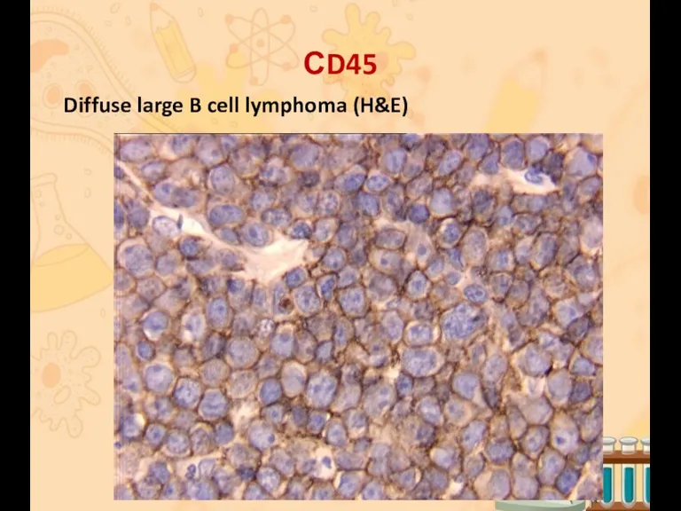 СD45 Diffuse large B cell lymphoma (H&E)