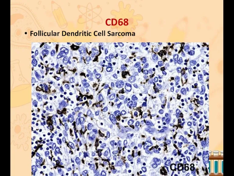 CD68 Follicular Dendritic Cell Sarcoma