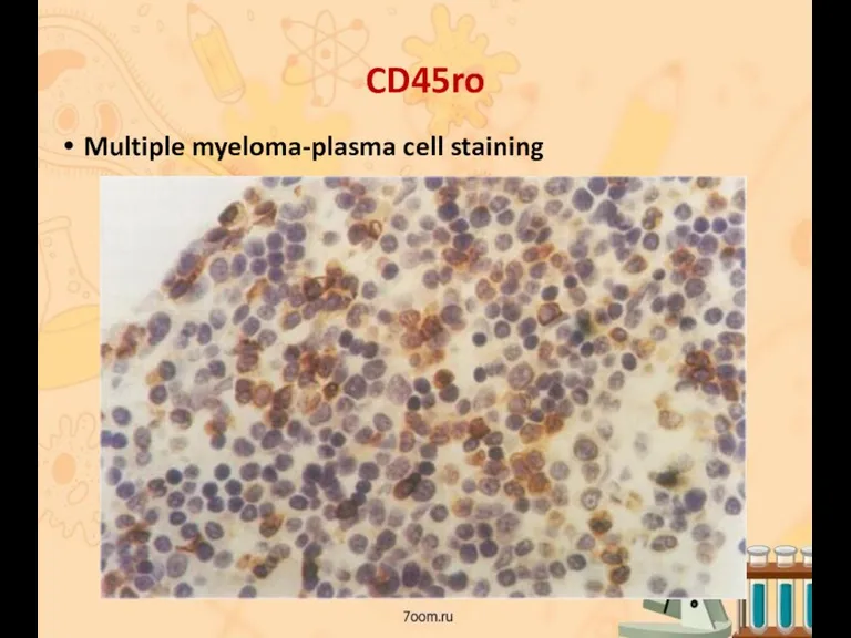 CD45ro Multiple myeloma-plasma cell staining