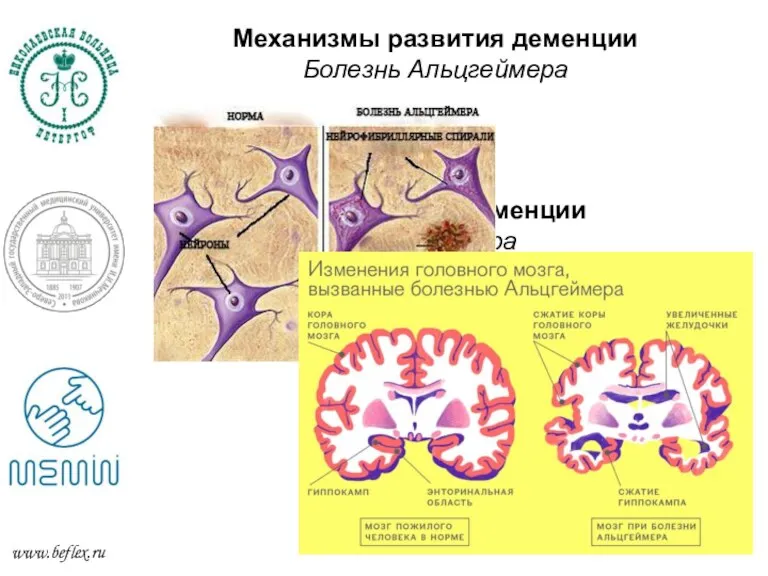 Механизмы развития деменции Болезнь Альцгеймера Механизмы развития деменции Болезнь Альцгеймера www.beflex.ru