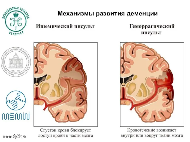 Механизмы развития деменции Механизмы развития деменции www.beflex.ru