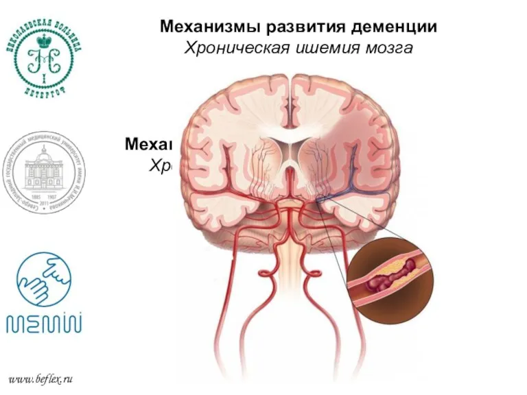 Механизмы развития деменции Хроническая ишемия мозга Механизмы развития деменции Хроническая ишемия мозга www.beflex.ru