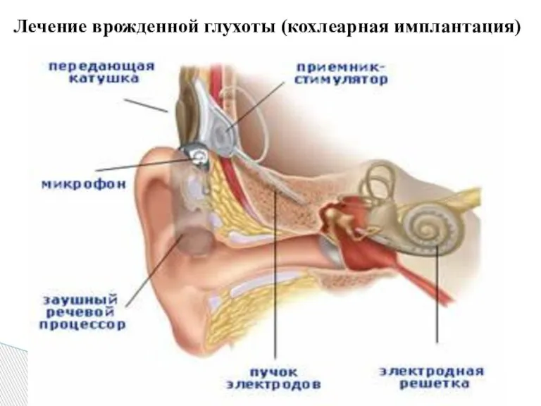 Лечение врожденной глухоты (кохлеарная имплантация)