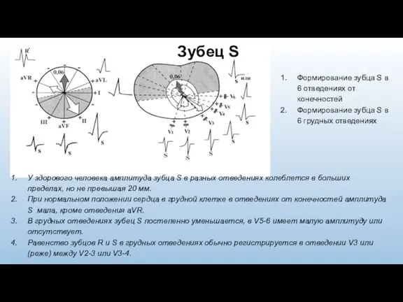 Формирование зубца S в 6 отведениях от конечностей Формирование зубца S в