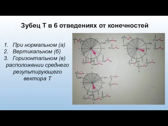 Зубец T в 6 отведениях от конечностей При нормальном (а) Вертикальном (б)