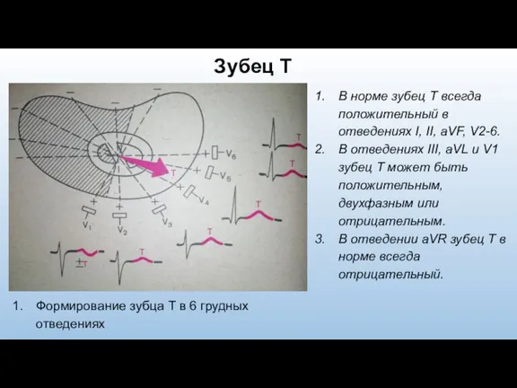 В норме зубец Т всегда положительный в отведениях I, II, aVF, V2-6.