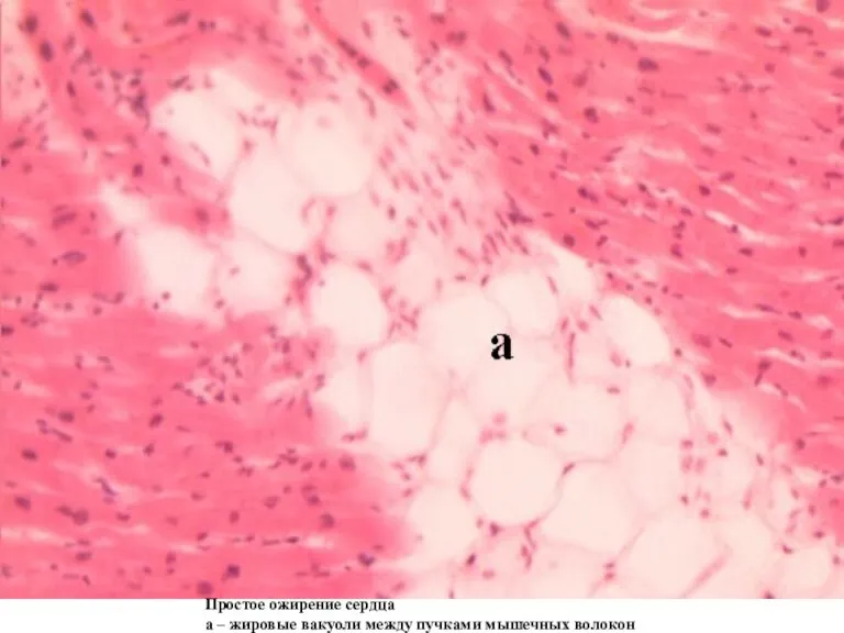 Простое ожирение сердца а – жировые вакуоли между пучками мышечных волокон