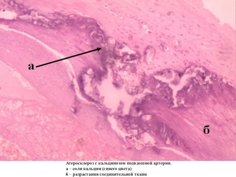 Атеросклероз с кальцинозом подвдошной артерии. а – соли кальция (синего цвета) б – разрастания соединительной ткани