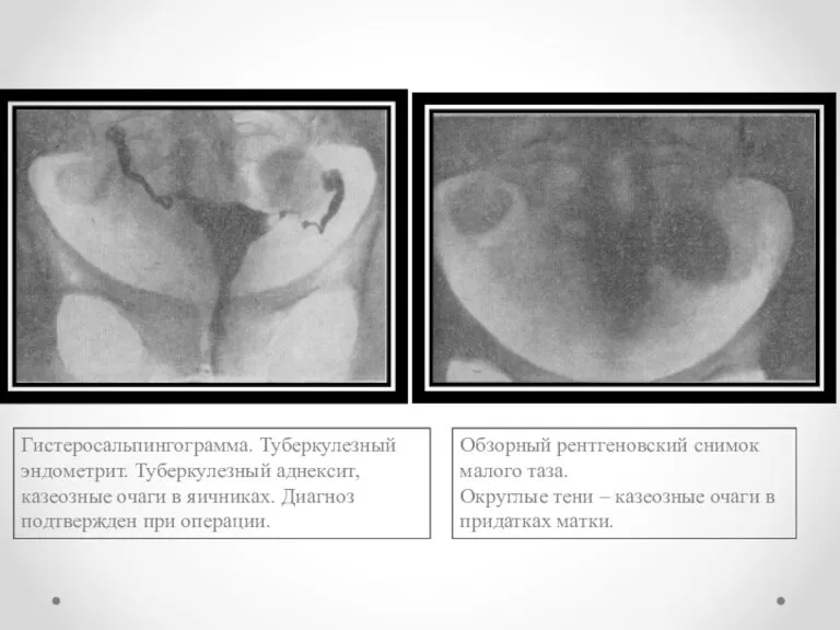 Обзорный рентгеновский снимок малого таза. Округлые тени – казеозные очаги в придатках