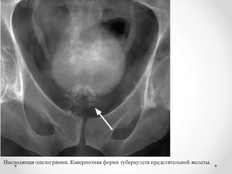 Нисходящая цистограмма. Кавернозная форма туберкулеза предстательной железы.