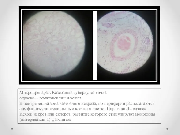 Микропрепарат: Казеозный туберкулез яичка окраска- - гематоксилин и эозин В центре видна
