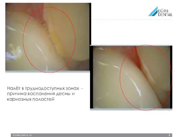 © DÜRR DENTAL AG Налёт в труднодоступных зонах - причина воспаления десны и кариозных полостей