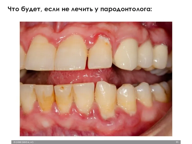 © DÜRR DENTAL AG Что будет, если не лечить у пародонтолога: