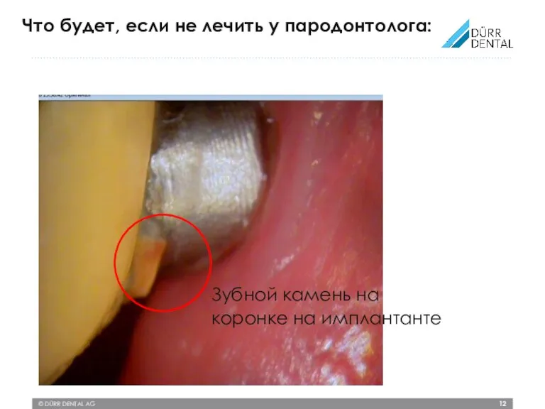 © DÜRR DENTAL AG Зубной камень на коронке на имплантанте Что будет,