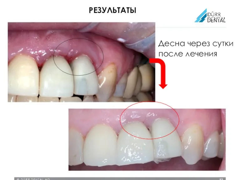 © DÜRR DENTAL AG Десна через сутки после лечения РЕЗУЛЬТАТЫ