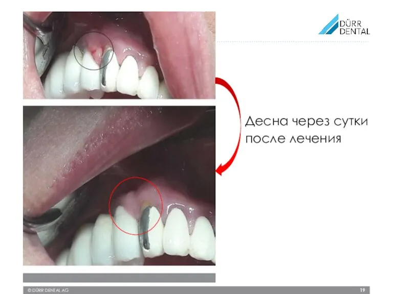 © DÜRR DENTAL AG Десна через сутки после лечения