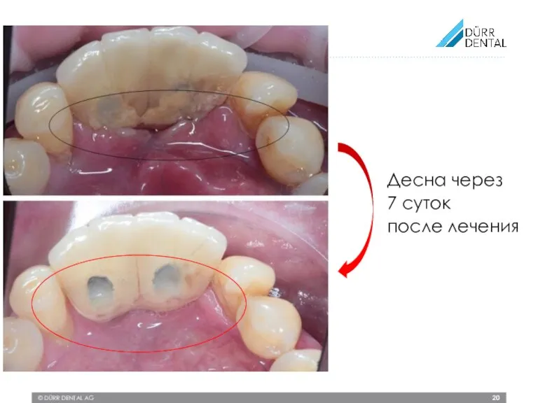 © DÜRR DENTAL AG Десна через 7 суток после лечения