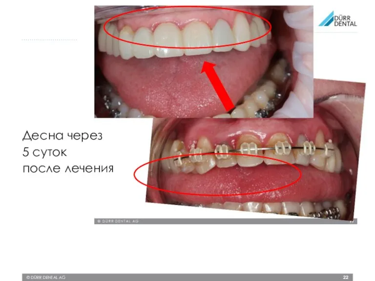 © DÜRR DENTAL AG Десна через 5 суток после лечения