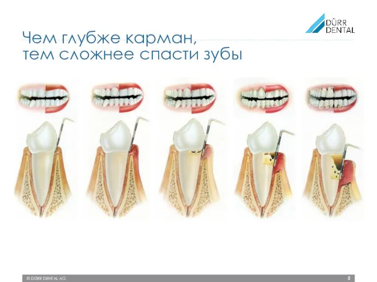 © DÜRR DENTAL AG Чем глубже карман, тем сложнее спасти зубы