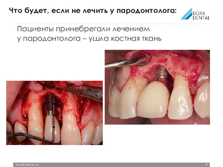 © DÜRR DENTAL AG Пациенты принебрегали лечением у пародонтолога – ушла костная