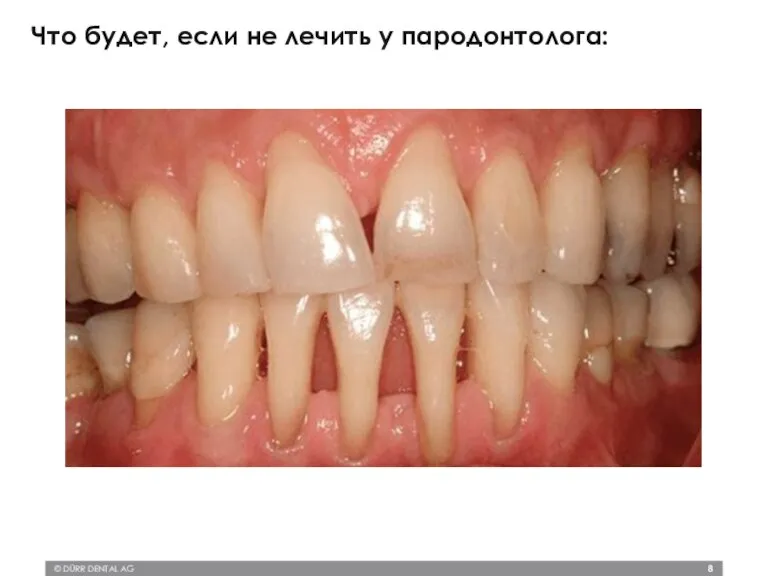 © DÜRR DENTAL AG Что будет, если не лечить у пародонтолога: