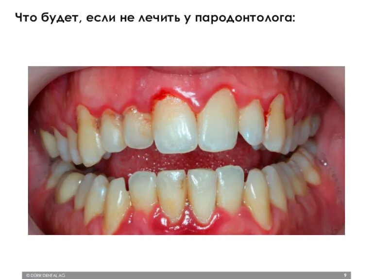 © DÜRR DENTAL AG Что будет, если не лечить у пародонтолога: