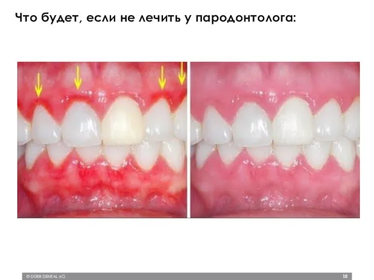 © DÜRR DENTAL AG Что будет, если не лечить у пародонтолога: