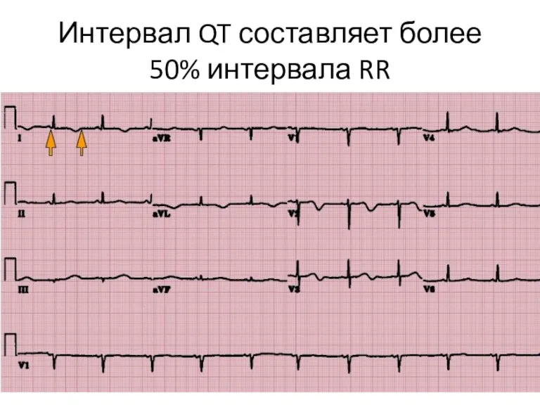 Интервал QT составляет более 50% интервала RR