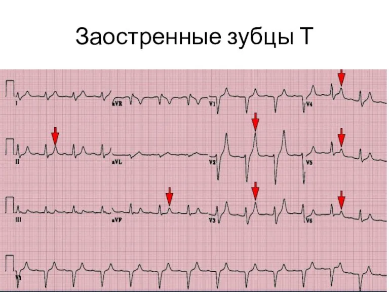 Заостренные зубцы Т