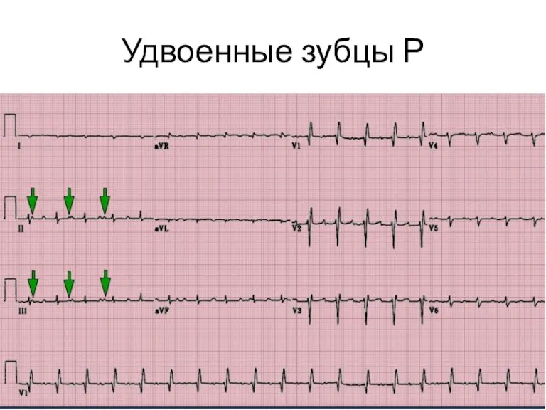 Удвоенные зубцы Р