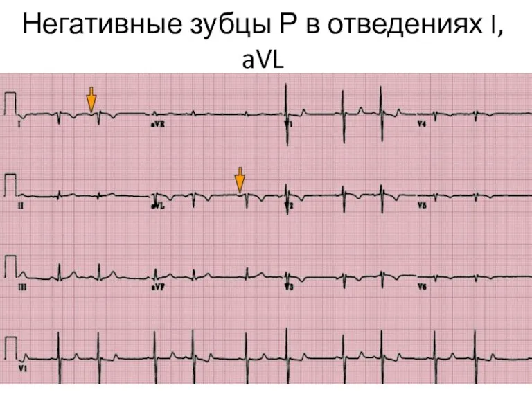 Негативные зубцы Р в отведениях I, aVL