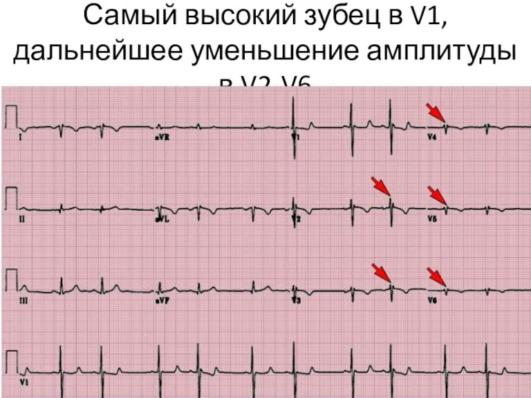 Самый высокий зубец в V1, дальнейшее уменьшение амплитуды в V2-V6