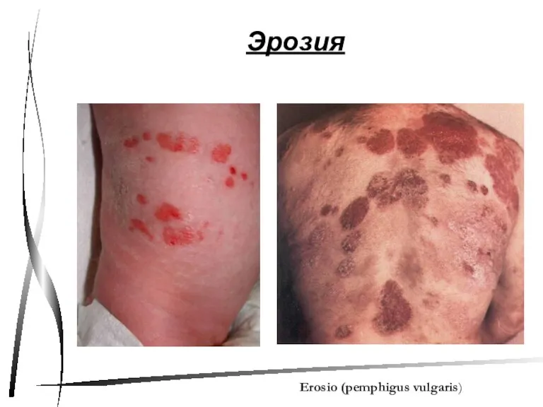 Эрозия Erosio (pemphigus vulgaris)