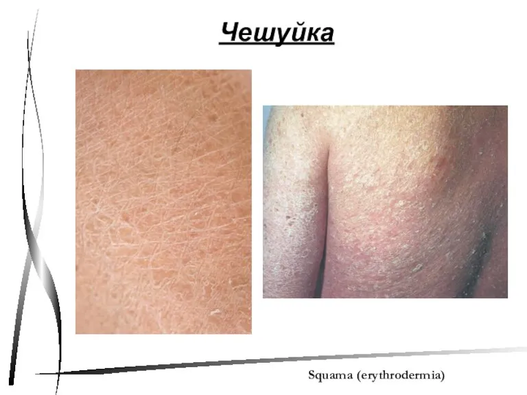 Чешуйка Squama (erythrodermia)