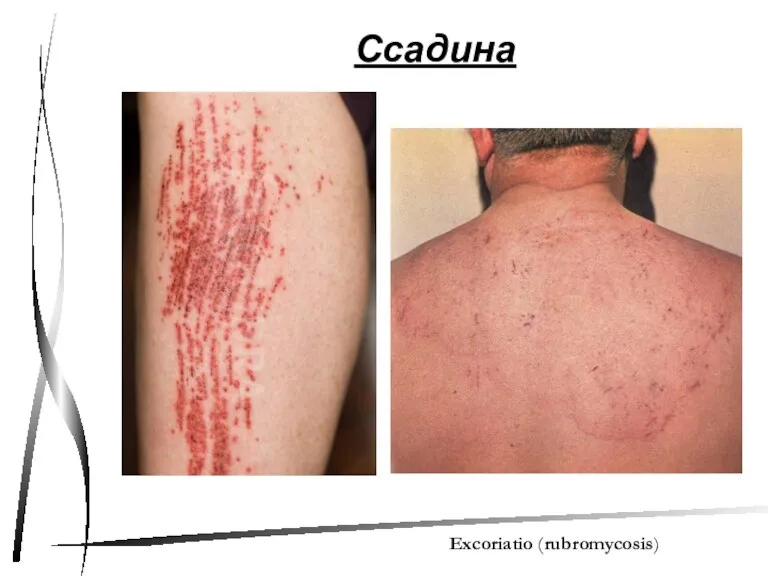 Ссадина Excoriatio (rubromycosis)