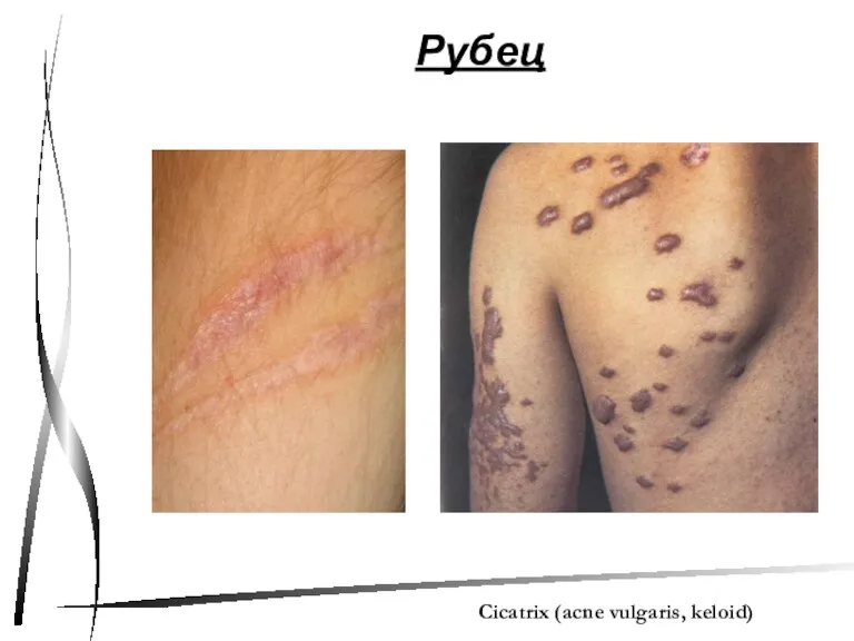 Рубец Cicatrix (acne vulgaris, keloid)