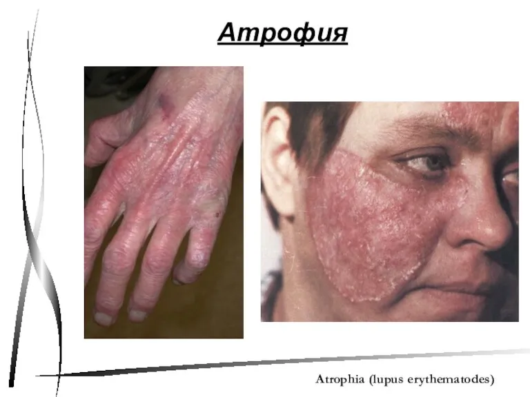 Атрофия Atrophia (lupus erythematodes)