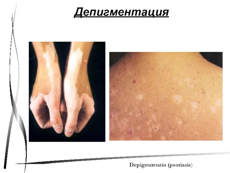 Депигментация Depigmentatio (psoriasis)