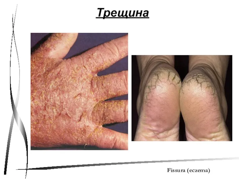 Трещина Fissura (eczema)
